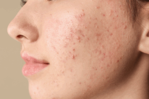 Acne Advanced Masterclass