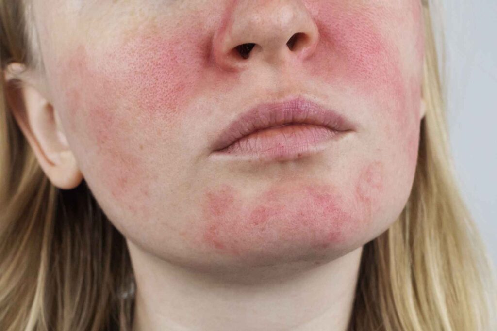rosacea