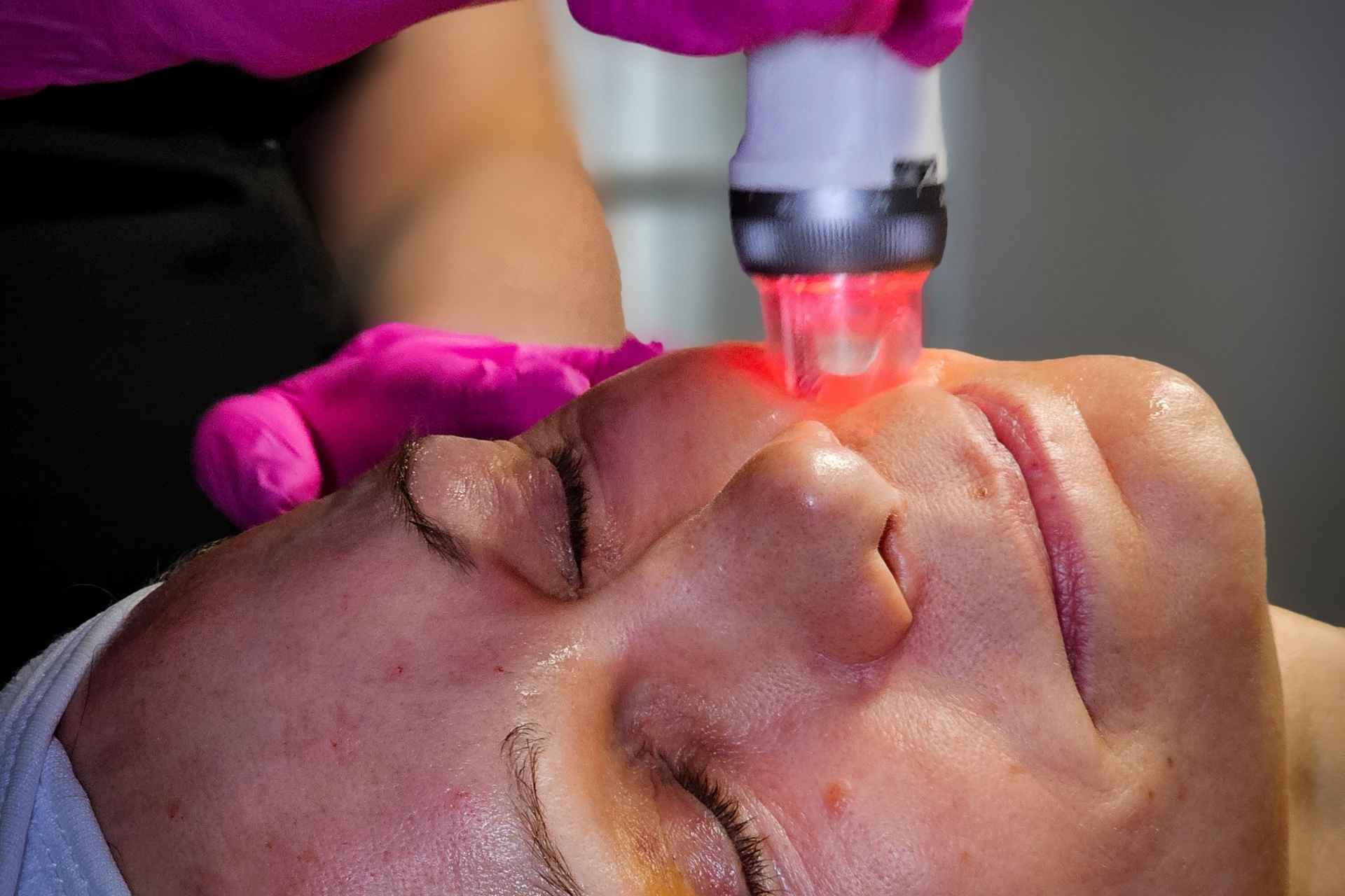 Skin Needling Course